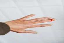 Vitamin C Deficiency Symptoms, Causes and Treatment